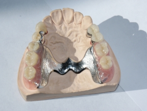 Denture with Bego CrCo Alloy