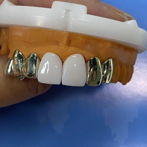Combination of zirconia and yellow gold crown
